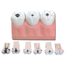 Fogszuvasodás oktató modell - 7 részes - 4x