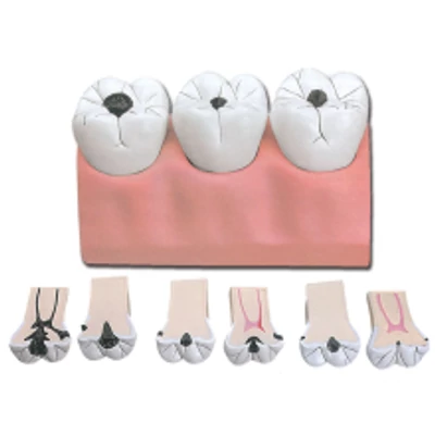 Fogszuvasodás oktató modell - 7 részes - 4x