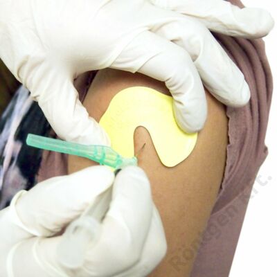 Shot blocker fájdalom blokkoló eszköz injekció beadáshoz